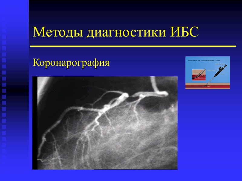 Методы диагностики ИБС Коронарография